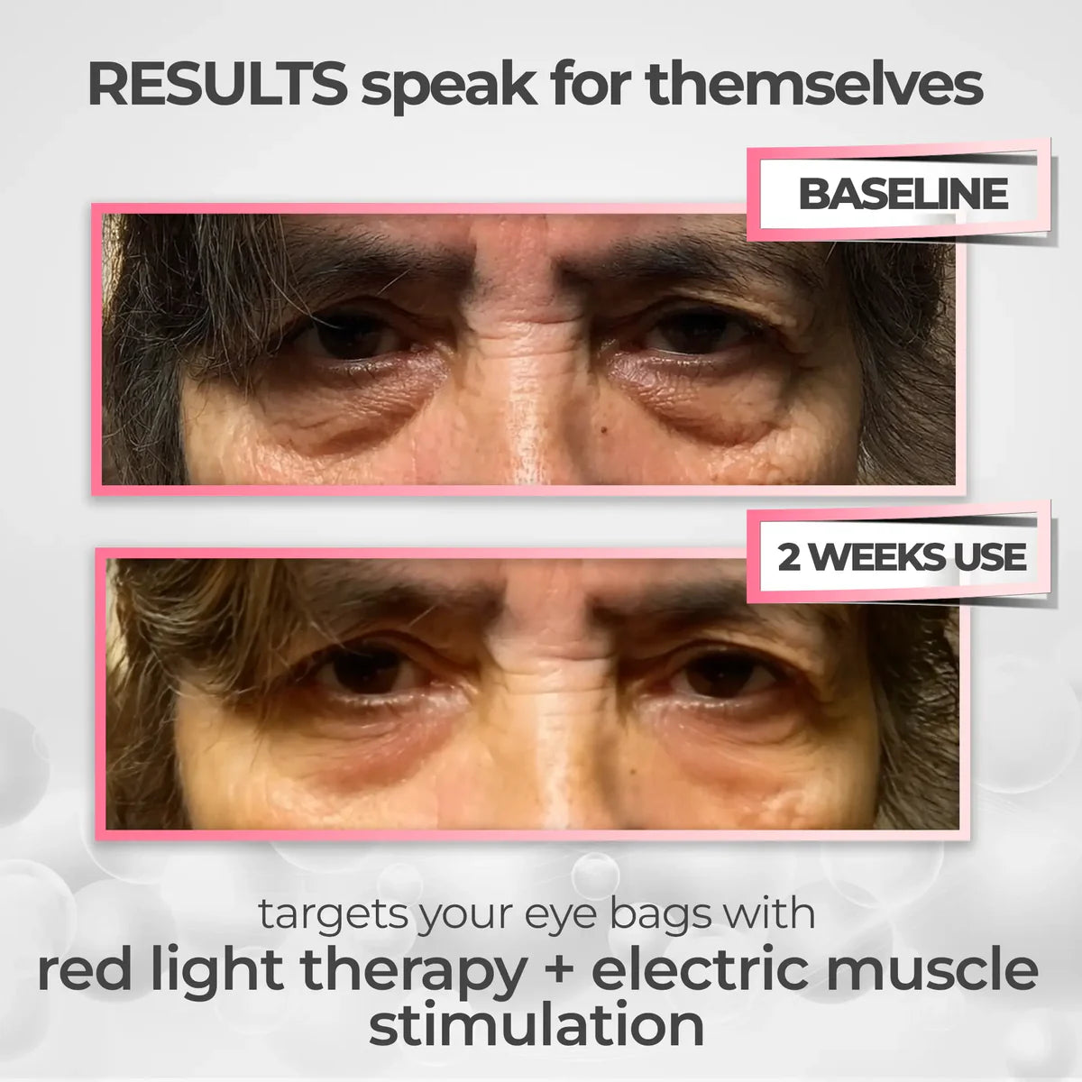 RevitalEyes® 2-in-1 Red Light Therapy + EMS To Erase Eye Bags
