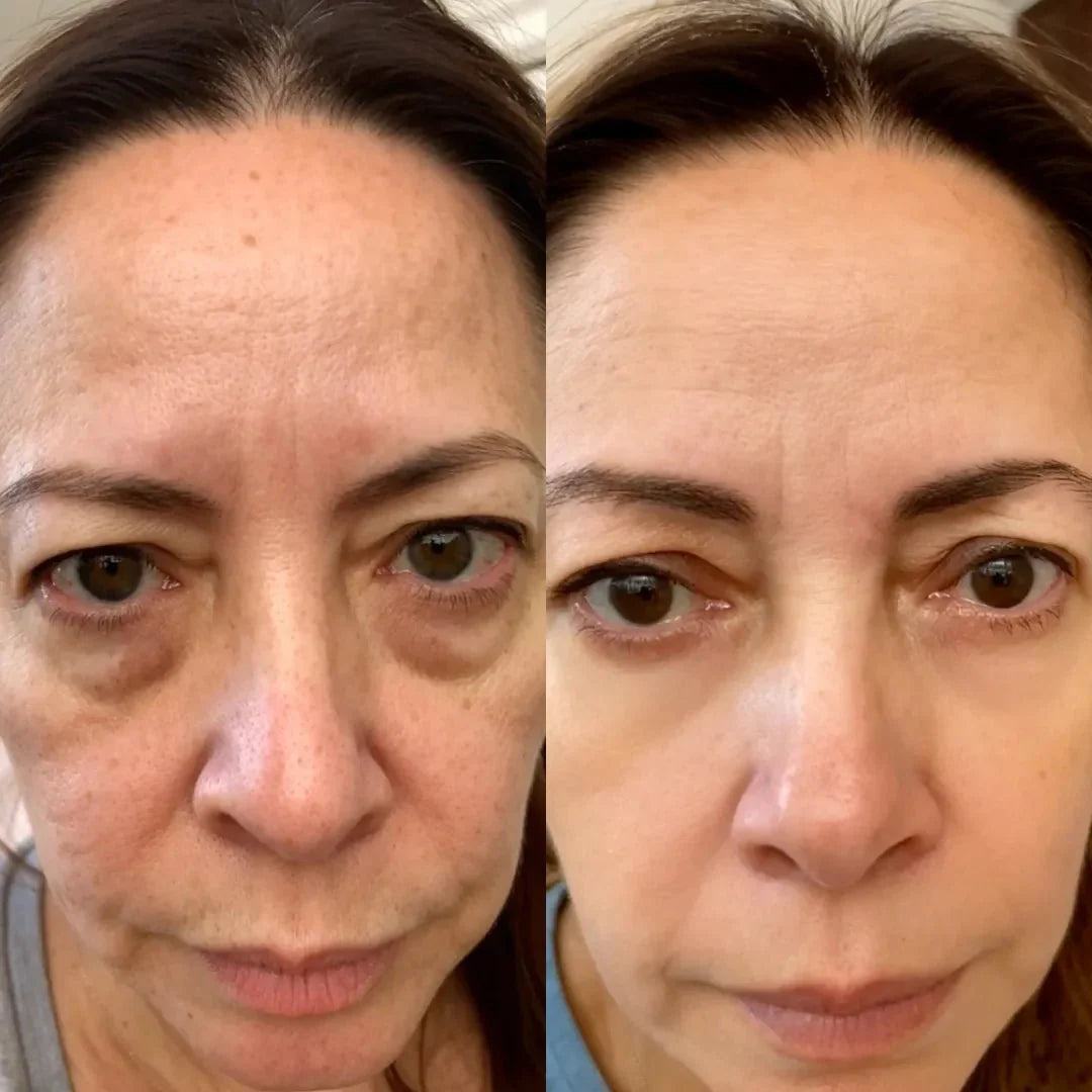 RevitalEyes® 2-in-1 Red Light Therapy + EMS To Erase Eye Bags